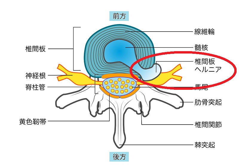 腰椎椎間板ヘルニア
