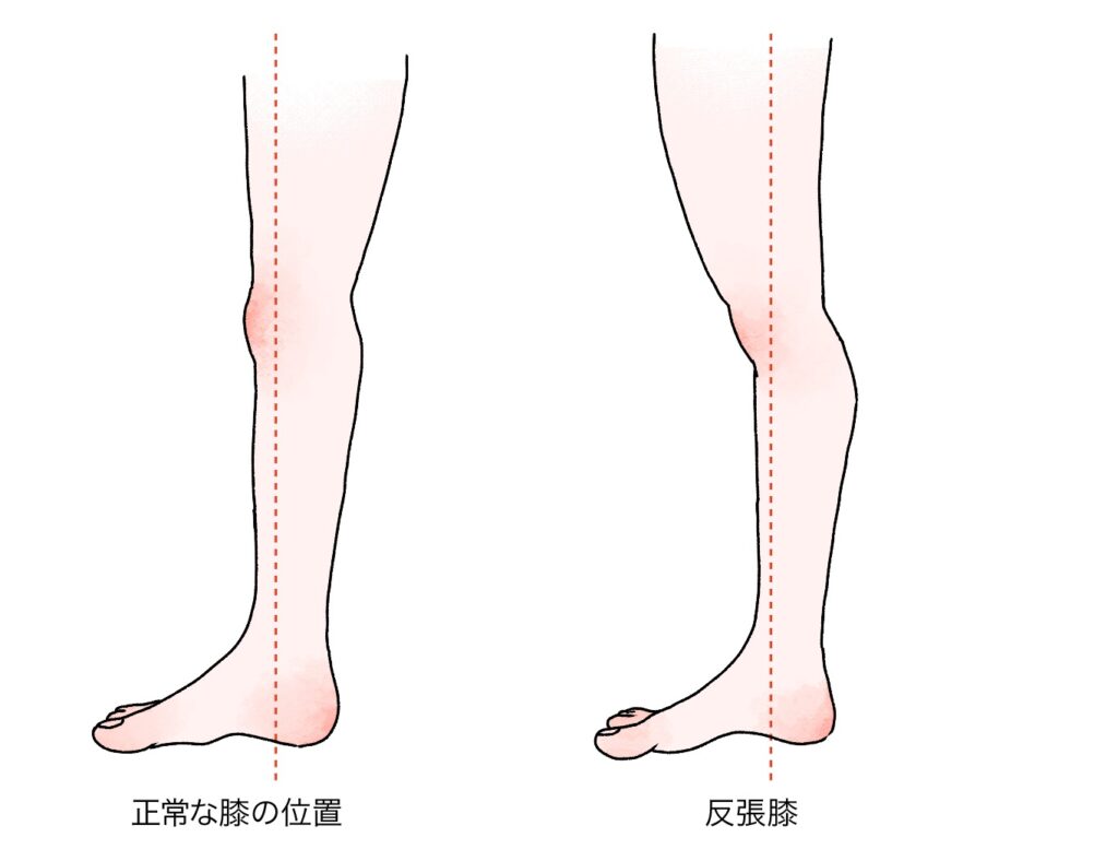 ひざが反りすぎている
