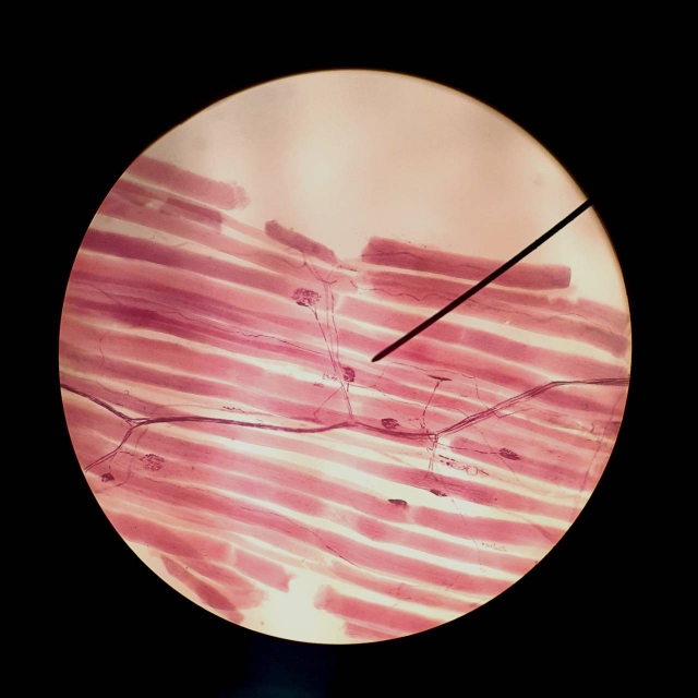 坐骨神経痛の本当の原因とは？